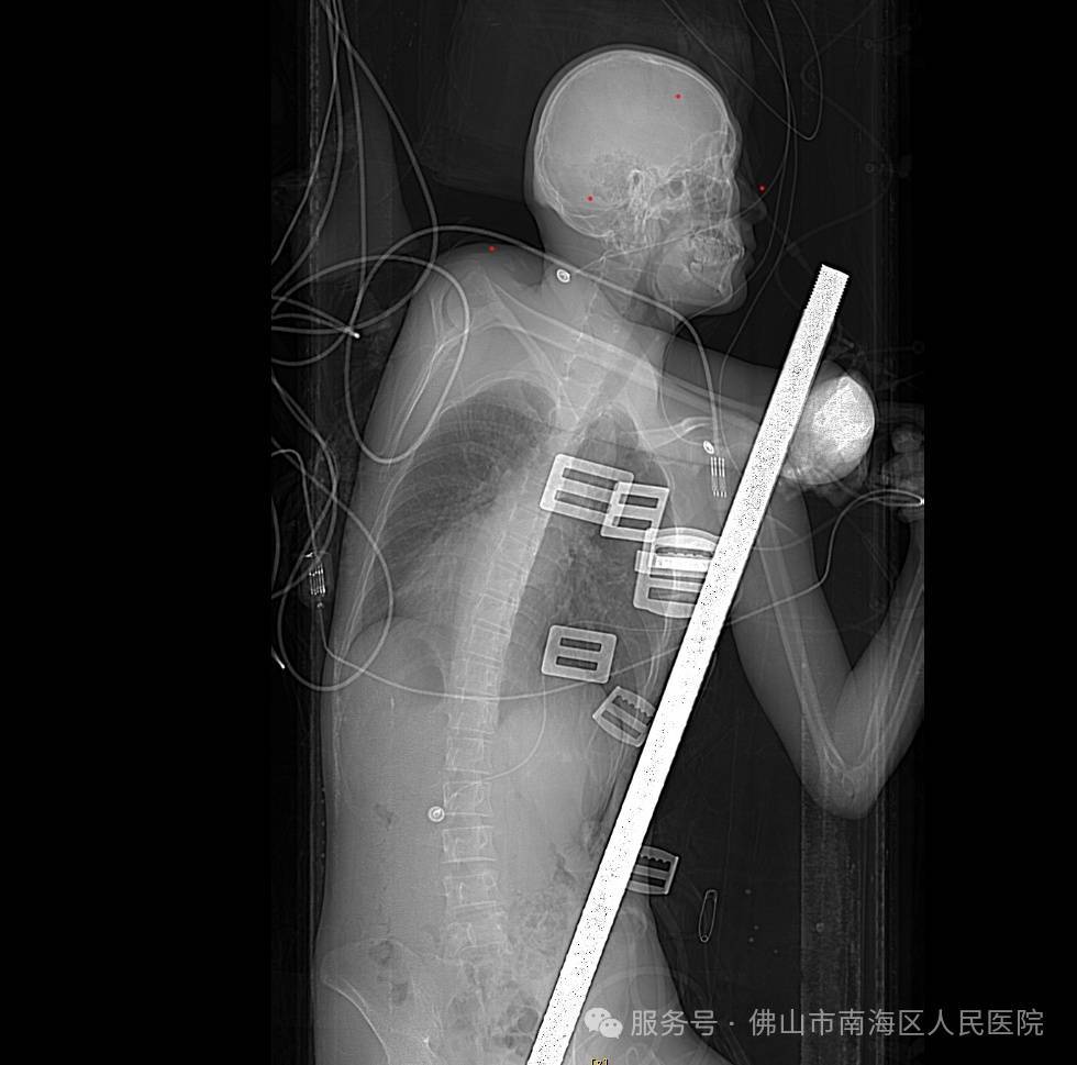 佛山一男子意外从高空坠落,1.5米长钢筋从肛门贯穿胸腔......