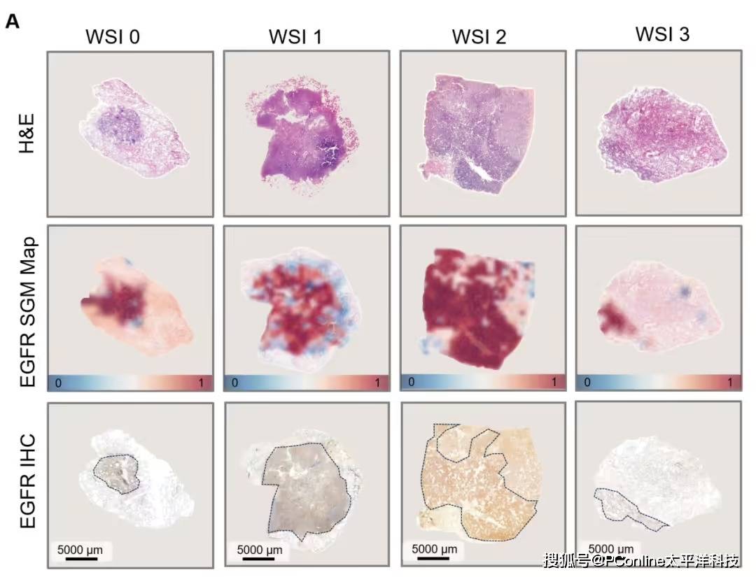 准确率高达 99%！腾讯 AI 可预测肺癌基因突变